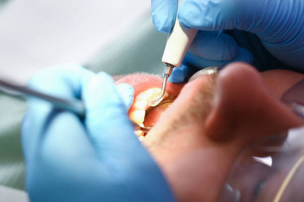 Best Emergency Wisdom Tooth Extraction in Porterdale, GA